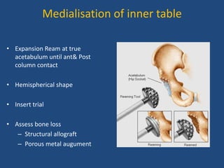 Medialisation of inner table
• Expansion Ream at true
acetabulum until ant& Post
column contact
• Hemispherical shape
• Insert trial
• Assess bone loss
– Structural allograft
– Porous metal augument
 