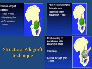 Structural Allograft
technique
 