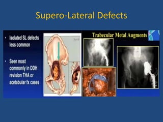 Supero-Lateral Defects
 