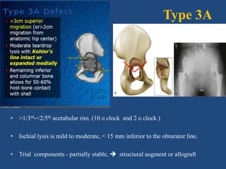 Type 3A
• >1/3rd-<2/5th acetabular rim. (10 o clock and 2 o clock )
• Ischial lysis is mild to moderate, < 15 mm inferior to the obturator line.
• Trial components - partially stable,  structural augment or allograft
 