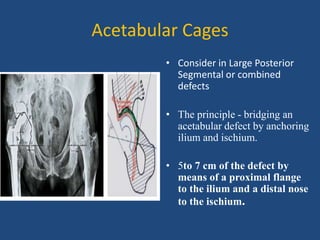 Acetabular Cages
• Consider in Large Posterior
Segmental or combined
defects
• The principle - bridging an
acetabular defect by anchoring
ilium and ischium.
• 5to 7 cm of the defect by
means of a proximal flange
to the ilium and a distal nose
to the ischium.
 