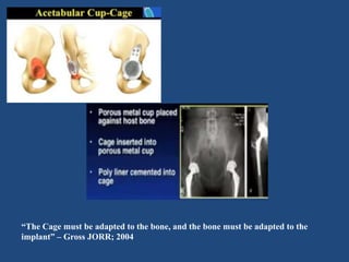 “The Cage must be adapted to the bone, and the bone must be adapted to the
implant” – Gross JORR; 2004
 