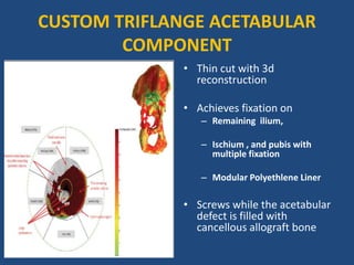 CUSTOM TRIFLANGE ACETABULAR
COMPONENT
• Thin cut with 3d
reconstruction
• Achieves fixation on
– Remaining ilium,
– Ischium , and pubis with
multiple fixation
– Modular Polyethlene Liner
• Screws while the acetabular
defect is filled with
cancellous allograft bone
 
