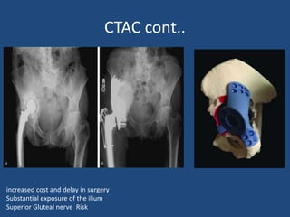 CTAC cont..
increased cost and delay in surgery
Substantial exposure of the ilium
Superior Gluteal nerve Risk
 