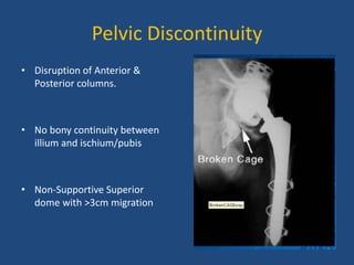 Pelvic Discontinuity
• Disruption of Anterior &
Posterior columns.
• No bony continuity between
illium and ischium/pubis
• Non-Supportive Superior
dome with >3cm migration
 