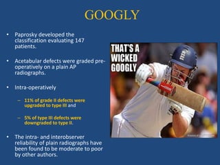 GOOGLY
• Paprosky developed the
classification evaluating 147
patients.
• Acetabular defects were graded pre-
operatively on a plain AP
radiographs.
• Intra-operatively
– 11% of grade II defects were
upgraded to type III and
– 5% of type III defects were
downgraded to type II.
• The intra- and interobserver
reliability of plain radiographs have
been found to be moderate to poor
by other authors.
 