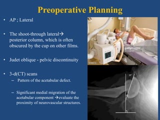 Preoperative Planning
• AP ; Lateral
• The shoot-through lateral
posterior column, which is often
obscured by the cup on other films.
• Judet oblique - pelvic discontinuity
• 3-d(CT) scans
– Pattern of the acetabular defect.
– Significant medial migration of the
acetabular component evaluate the
proximity of neurovascular structures.
 