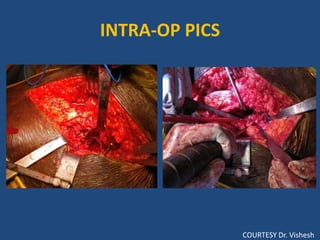INTRA-OP PICS
COURTESY Dr. Vishesh
 