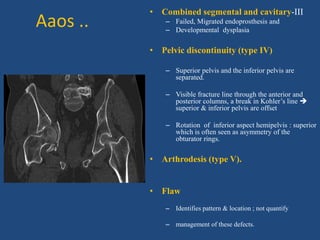 Aaos ..
• Combined segmental and cavitary-III
– Failed, Migrated endoprosthesis and
– Developmental dysplasia
• Pelvic discontinuity (type IV)
– Superior pelvis and the inferior pelvis are
separated.
– Visible fracture line through the anterior and
posterior columns, a break in Kohler’s line 
superior & inferior pelvis are offset
– Rotation of inferior aspect hemipelvis : superior
which is often seen as asymmetry of the
obturator rings.
• Arthrodesis (type V).
• Flaw
– Identifies pattern & location ; not quantify
– management of these defects.
 