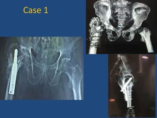 Case 1
 