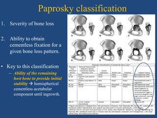 Paprosky classification
1. Severity of bone loss
2. Ability to obtain
cementless fixation for a
given bone loss pattern.
• Key to this classification
– Ability of the remaining
host bone to provide initial
stability  hemispherical
cementless acetabular
component until ingrowth.
 