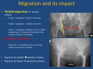 Migration and its impact
• Medial migration  anterior
column.
– Grade 1 migration- Lateral to line and
– Grade 3 migration. - medial to the line
– Grade 2 migration to Kohler’s line or slight
remodeling of iliopubic & ilioischial lines
without a break in continuity.
• Superior migration
– Bone loss in acetabular dome involving
anterior & posterior columns
• Superior & medial anterior column.
• Superior & lateral  posterior column.
 