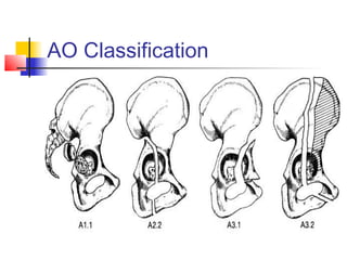 Acetabular fraacture management with surgical approaches | PPT