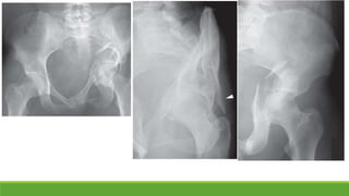 Acetabular | PPTX