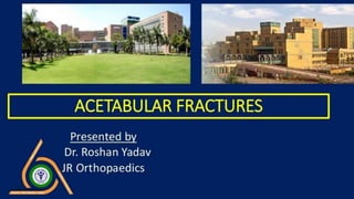 Acetabular fracture