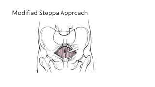 Acetabular fracture new | PPTX