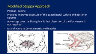 Acetabular fracture ppt 4th sem | PPTX