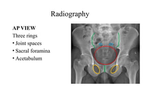 acetabularfractureppt4thsem-191025183803.pptx