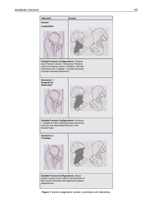 Acetabular fractures | PDF