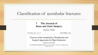 Classification of acetabular fractures
 