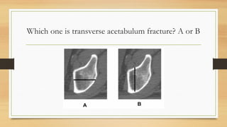 Which one is transverse acetabulum fracture? A or B
 