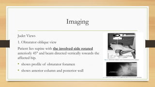 Imaging
Judet Views
1. Obturator oblique view
Patient lies supine with the involved side rotated
anteriorly 45° and beam directed vertically towards the
affected hip.
• shows profile of obturator foramen
• shows anterior column and posterior wall
 