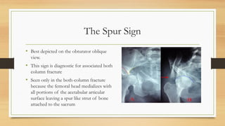 The Spur Sign
• Best depicted on the obturator oblique
view.
• This sign is diagnostic for associated both
column fracture
• Seen only in the both-column fracture
because the femoral head medializes with
all portions of the acetabular articular
surface leaving a spur like strut of bone
attached to the sacrum
 