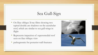Sea Gull-Sign
• On Iliac oblique X ray films showing two
‐
typical double arc shadows on the acetabular
roof, which are similar to sea gull wings in
flight
• Represents impaction of superomedial roof
seen on iliac oblique view
• pathognomic for posterior wall fractures
 