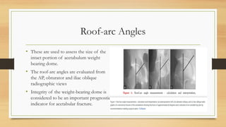 Roof-arc Angles
• These are used to assess the size of the
intact portion of acetabulum weight
bearing dome.
• The roof-arc angles are evaluated from
the AP, obturator and iliac oblique
radiographic views
• Integrity of the weight-bearing dome is
considered to be an important prognostic
indicator for acetabular fracture.
 
