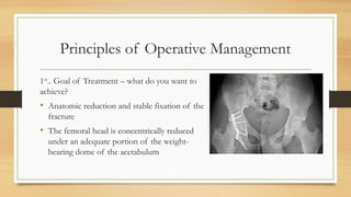Principles of Operative Management
1st
.. Goal of Treatment – what do you want to
achieve?
• Anatomic reduction and stable fixation of the
fracture
• The femoral head is concentrically reduced
under an adequate portion of the weight-
bearing dome of the acetabulum
 