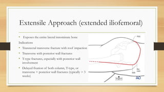 Extensile Approach (extended iliofemoral)
• Exposes the entire lateral innominate bone
Indications
• Transtectal transverse fracture with roof impaction
• Transverse with posterior wall fractures
• T-type fractures, especially with posterior wall
involvement
• Delayed fixation of both column, T-type, or
transverse + posterior wall fractures (typically > 3
weeks)
 