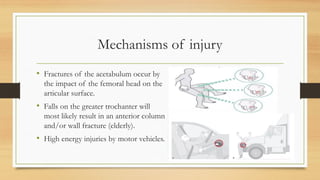 Mechanisms of injury
• Fractures of the acetabulum occur by
the impact of the femoral head on the
articular surface.
• Falls on the greater trochanter will
most likely result in an anterior column
and/or wall fracture (elderly).
• High energy injuries by motor vehicles.
 