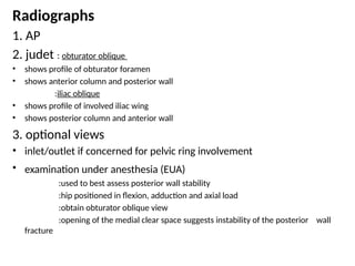 Acetabular Fractures a very brief summary | PPTX