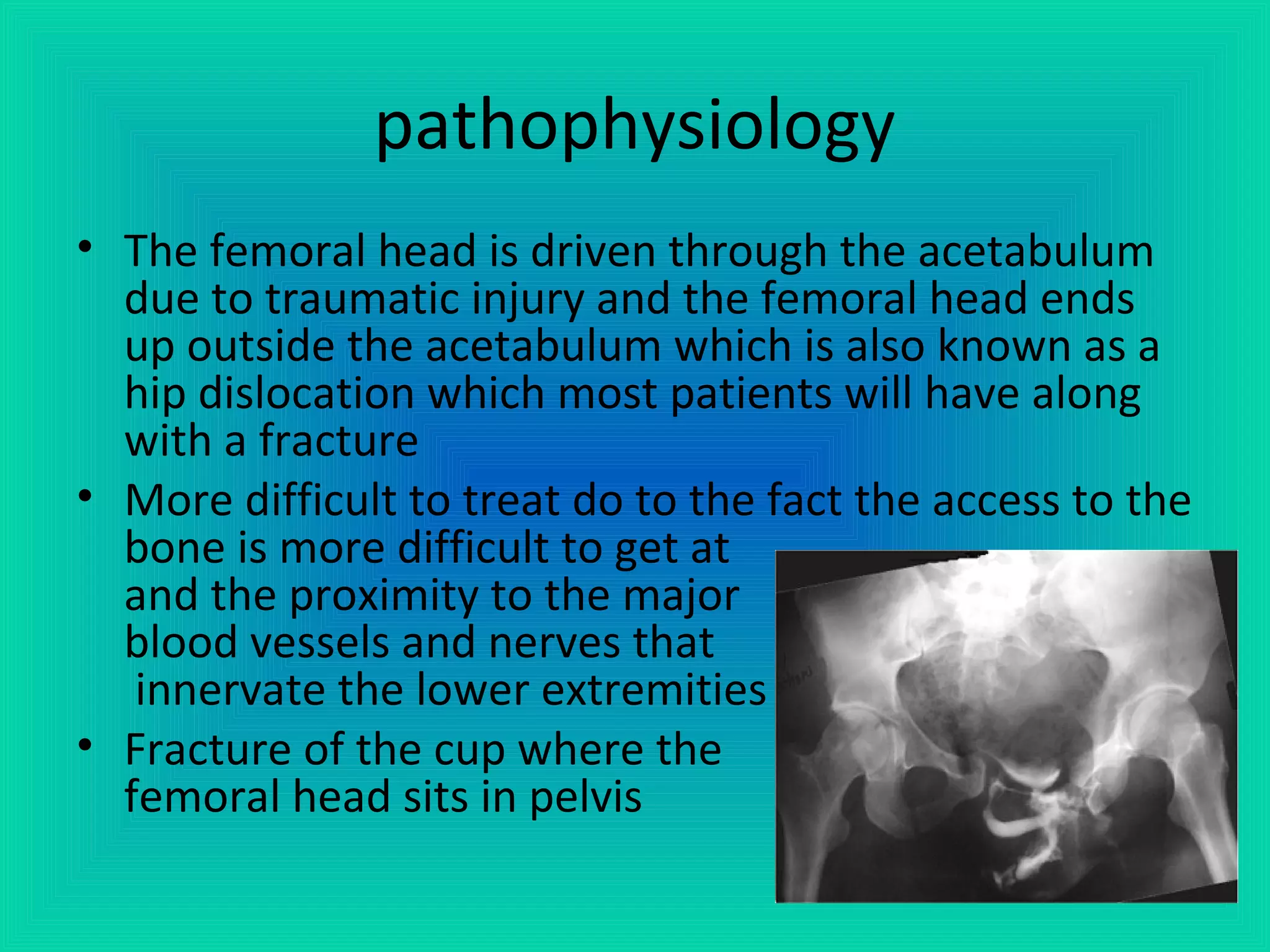 Acetabular Fractures | PPT