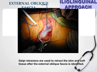 EXTERNAL OBLIQUE
FASCIA

Gelpi retractors are used to retract the skin and soft
tissue after the external oblique fascia is identified.

 