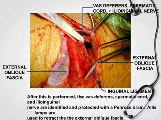 VAS DEFERENS, SPERMATIC
CORD, + ILIOINGUINAL NERVE

EXTERNAL
OBLIQUE
FASCIA

EXTERNAL
OBLIQUE
FASCIA

INGUINAL LIGAMENT
After this is performed, the vas deferens, spermatic cord,
and ilioinguinal
nerve are identified and protected with a Penrose drain. Allis
c lamps are
used to retract the the external oblique fascia.

 