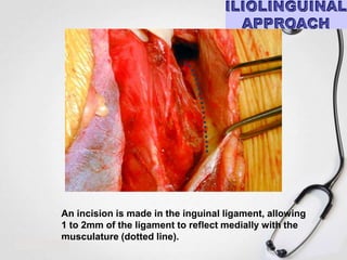 An incision is made in the inguinal ligament, allowing
1 to 2mm of the ligament to reflect medially with the
musculature (dotted line).

 
