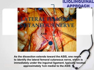 LATERAL FEMORAL
CUTANEOUS NERVE
ASIS

As the dissection extends toward the ASIS, one needs
to identify the lateral femoral cutaneous nerve, which is
immediately under the inguinal ligament. typically located
approximately 1cm medial to the ASIS

 