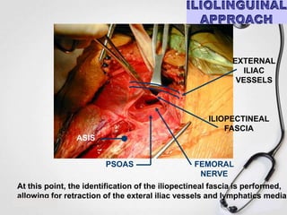 EXTERNAL
ILIAC
VESSELS

ILIOPECTINEAL
FASCIA
ASIS
PSOAS

FEMORAL
NERVE

At this point, the identification of the iliopectineal fascia is performed,
allowing for retraction of the exteral iliac vessels and lymphatics medial

 