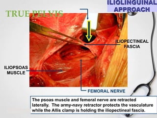 TRUE PELVIS
ILIOPECTINEAL
FASCIA

ILIOPSOAS
MUSCLE

FEMORAL NERVE
The psoas muscle and femoral nerve are retracted
laterally. The army-navy retractor protects the vasculature
while the Allis clamp is holding the iliopectineal fascia.

 