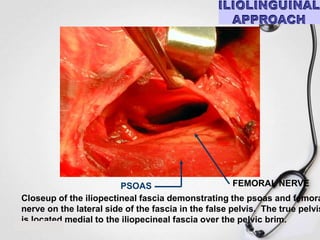 FEMORAL NERVE
PSOAS
Closeup of the iliopectineal fascia demonstrating the psoas and femora
nerve on the lateral side of the fascia in the false pelvis. The true pelvis
is located medial to the iliopecineal fascia over the pelvic brim.

 