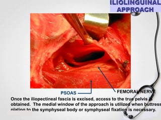 FEMORAL NERVE
PSOAS
Once the iliopectineal fascia is excised, access to the true pelvis is
obtained. The medial window of the approach is utilized when buttress
plating to the symphyseal body or symphyseal fixation is necessary.

 