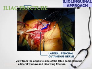 ILIAC FRACTURE

LATERAL FEMORAL
CUTANEOUS NERVE
View from the opposite side of the table demonstrating
the lateral window and iliac wing fracture.

 