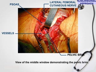 PSOAS

LATERAL FEMORAL
CUTANEOUS NERVE

VESSELS

PELVIC BRIM
View of the middle window demonstrating the pelvic brim.

 