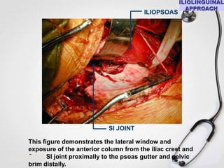 ILIOPSOAS

SI JOINT
This figure demonstrates the lateral window and
exposure of the anterior column from the iliac crest and
S
SI joint proximally to the psoas gutter and pelvic
brim distally.

 