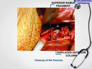 SUPERIOR RAMUS
FRAGMENT

DISPLACED ANTERIOR
COLUMN
Closeup of the fracture.

 