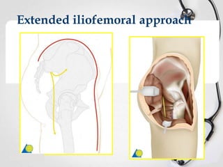 Extended iliofemoral approach

 