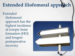 Extended iliofemoral approach
Extended
iliofemoral
approach has the
highest incidence
of ectopic bone
formation (HO)
and longest
postoperative
recovery

 