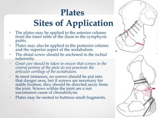 Plates
Sites of Application
•
•
•
•
•

•

The plates may be applied to the anterior column
from the inner table of the ilium to the symphysis
pubis.
Plates may also be applied to the posterior column
and the superior aspect of the acetabulum.
The distal screw should be anchored in the ischial
tuberosity.
Great care should be taken to ensure that screws in the
central portion of the plate do not penetrate the
articular cartilage of the acetabulum.
In most instances, no screws should be put into
that danger area, but if screws are necessary for
stable fixation, they should be directed away from
the joint. Screws within the joint are a not
uncommon cause of chondrolysis.
Plates may be nested to buttress small fragments.

 