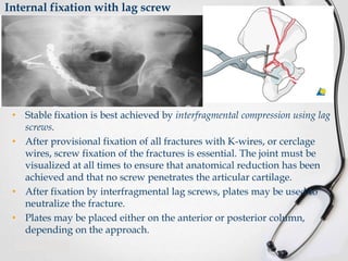 Internal fixation with lag screw

• Stable fixation is best achieved by interfragmental compression using lag
screws.
• After provisional fixation of all fractures with K-wires, or cerclage
wires, screw fixation of the fractures is essential. The joint must be
visualized at all times to ensure that anatomical reduction has been
achieved and that no screw penetrates the articular cartilage.
• After fixation by interfragmental lag screws, plates may be used to
neutralize the fracture.
• Plates may be placed either on the anterior or posterior column,
depending on the approach.

 